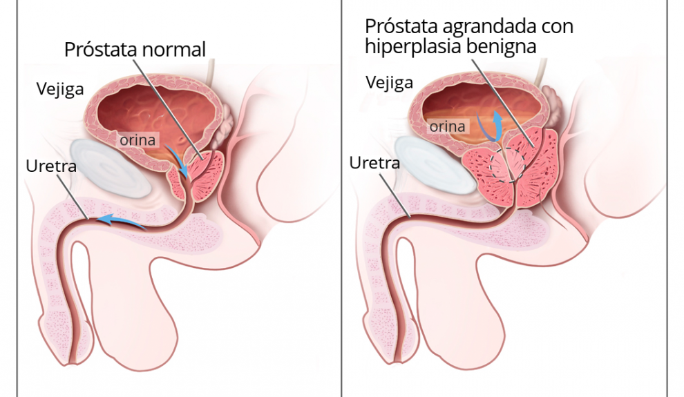 Hiperplasia benigna de próstata | Foto: Kimedia